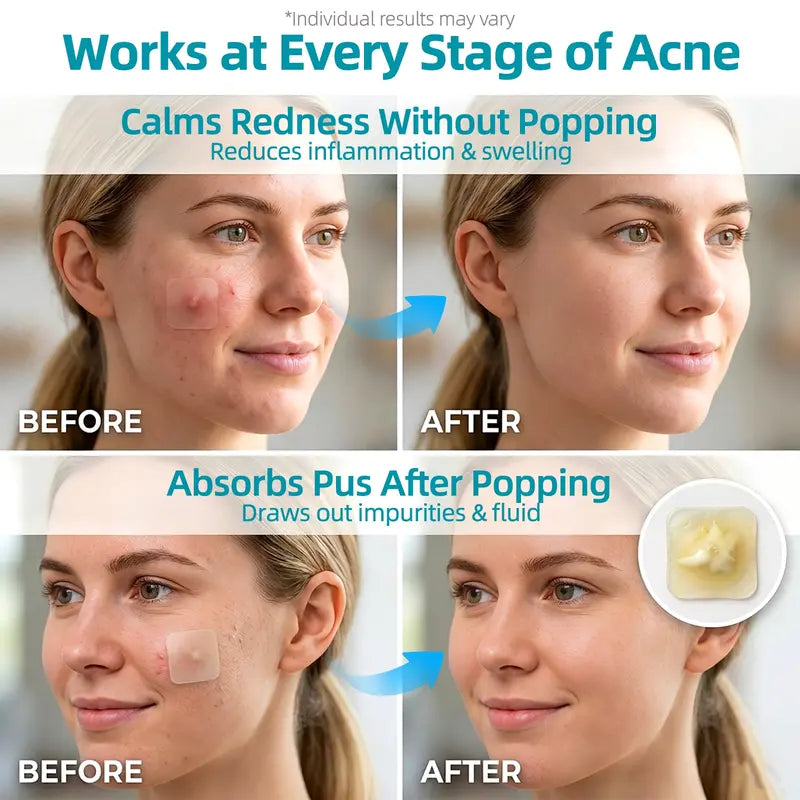Zintlo™ Hydrocolloid Patch Roll – Cut-to-Size Acne & Blemish Care