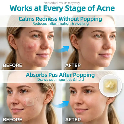 Zintlo™ Hydrocolloid Patch Roll – Cut-to-Size Acne & Blemish Care