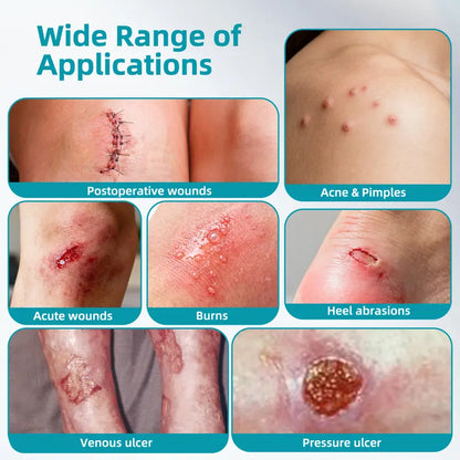 Zintlo™ Hydrocolloid Patch Roll – Cut-to-Size Acne & Blemish Care